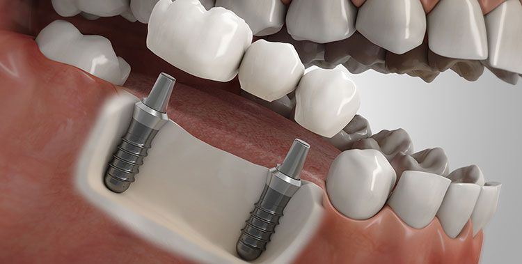 Größere Zahnlücke